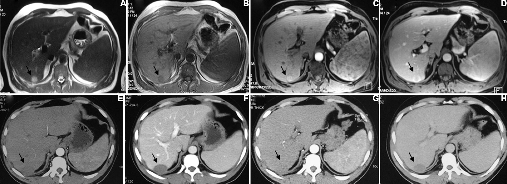 A 50 yr old male with hepatocellular carcinoma in segment 7/6 of liver treated with radiofrequency ablation and alcohol. Pre-treatment MRI shows a hyperintense lesion on T2-weighted images (A) which is hypointense on T1-weighted images (B) and is showing arterial hypervascularity (C) and wash out on portal venous phase (D) (arrows). Post-treatment follow up imaging at three months (E & F) and six months (G & H) shows no residual enhancement in the lesion (arrows).
